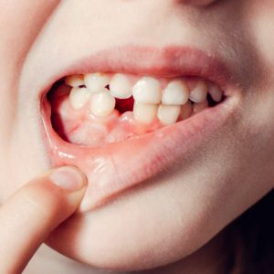 implant-image1