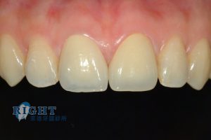 rootcanal-case2-2
